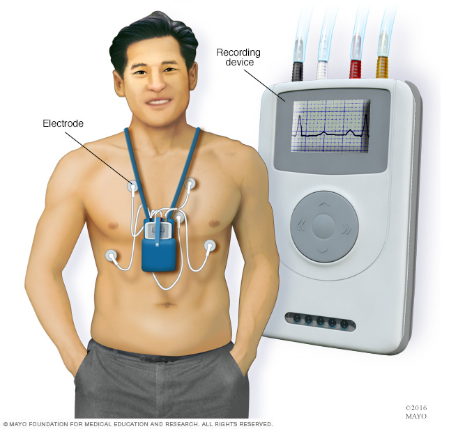 Holter điện tim là gì