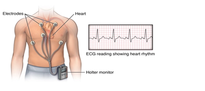 Ý nghĩa của sử dụng Holter điện tim