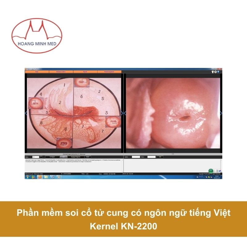Giao diện phần mềm soi cổ tử cung Kernel KN-2200 hỗ trợ tiếng Việt cho bác sĩ dễ dàng thao tác.